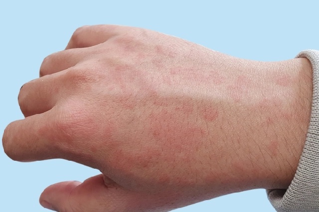 Dị ứng Trầm Hương: Nguyên nhân và biện pháp xử lý an toàn